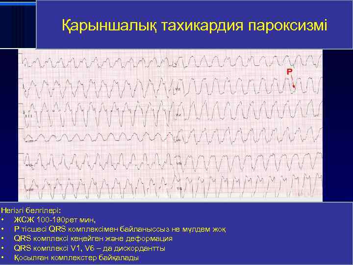 Пароксизмальная желудочковая Қарыншалық тахикардия пароксизмі тахикардия Негізгі белгілері: • ЖСЖ 100 -190 рет мин,