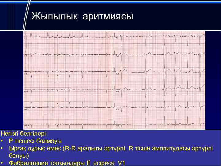 Жыпылық аритмиясы Негізгі белгілері: • Р тісшесі болмауы • Ырғақ дұрыс емес (R-R аралығы