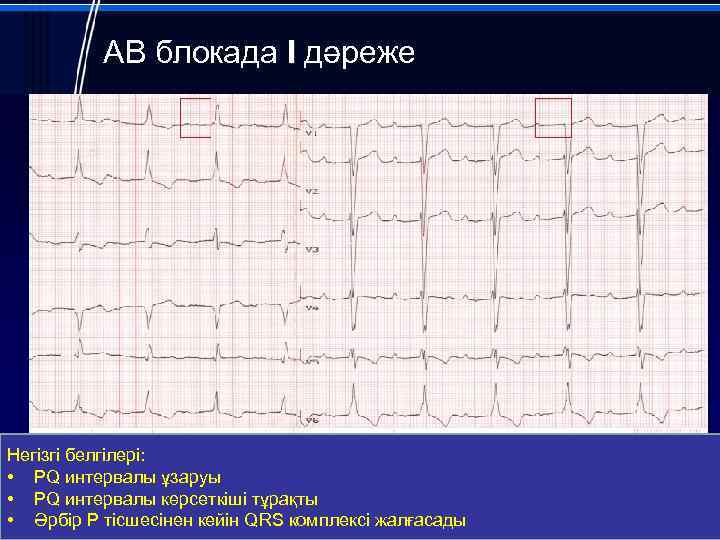 АВ блокада I дәреже Негізгі белгілері: • PQ интервалы ұзаруы • PQ интервалы көрсеткіші