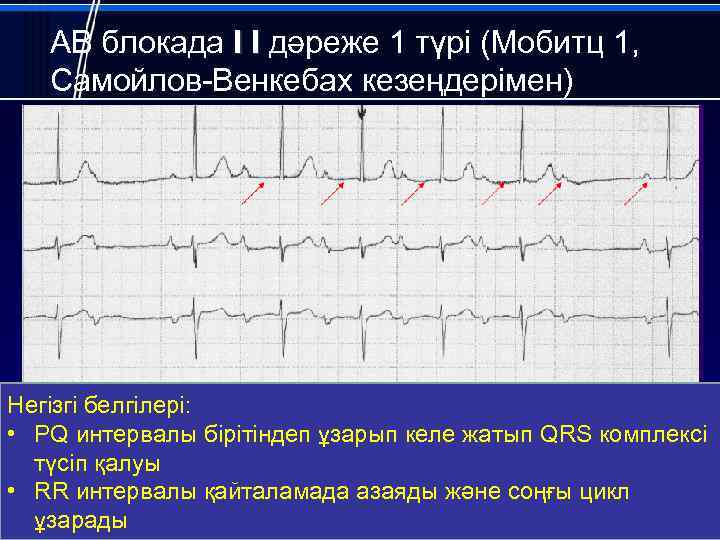 АВ блокада I I дәреже 1 түрі (Мобитц 1, Самойлов-Венкебах кезеңдерімен) Негізгі белгілері: •