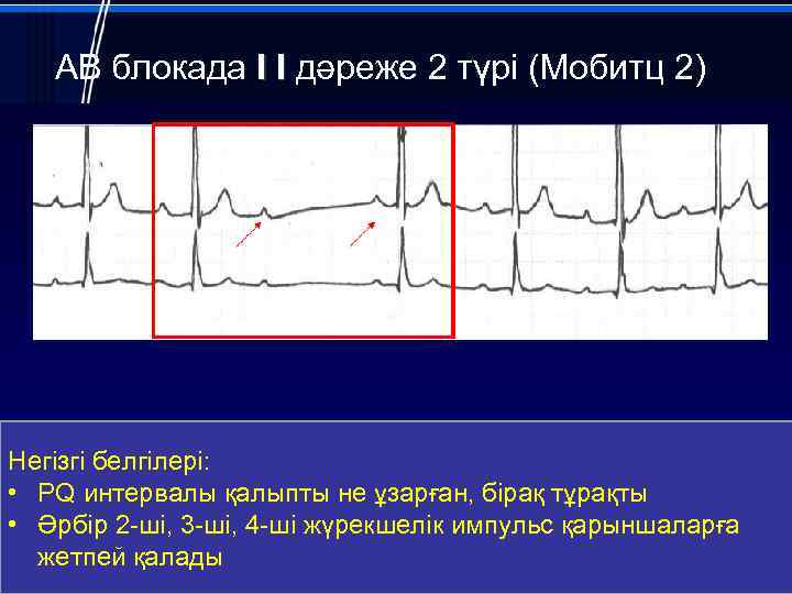 АВ блокада I I дәреже 2 түрі (Мобитц 2) Негізгі белгілері: • PQ интервалы