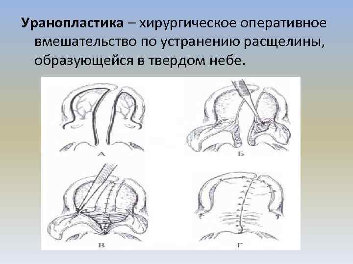 Уранопластика детям: что это такое, радикальная …