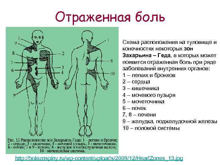 Отраженная боль Схема расположения на туловище и конечностях некоторых зон Захарьина – Геда, в