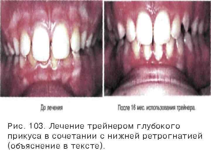 Рис. 103. Лечение трейнером глубокого прикуса в сочетании с нижней ретрогнатией (объяснение в тексте).