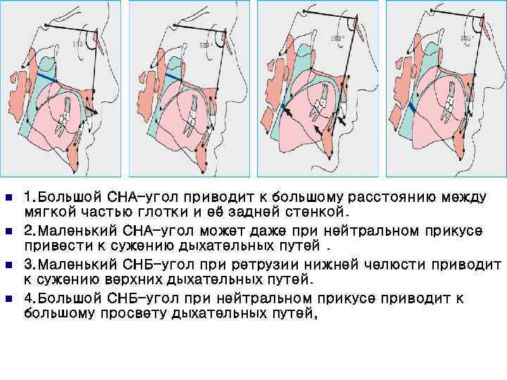 n n 1. Большой СНА-угол приводит к большому расстоянию между мягкой частью глотки и