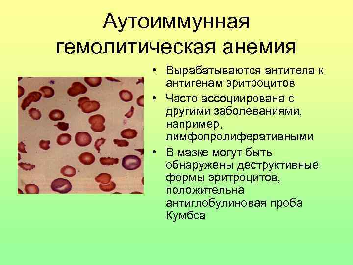 Анемия гемолитического типа. Гемолитическая анемия проба Кумбса. Аутоиммунная гемолитическая анемия симптомы. Иммунные гемолитические анемии картина крови. Приобретенная гемолитическая анемия картина крови.