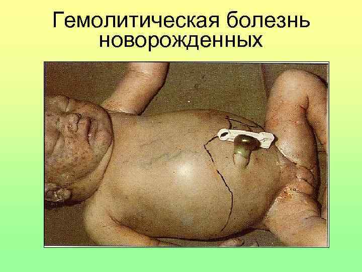 Гемолитическая болезнь новорожденных 