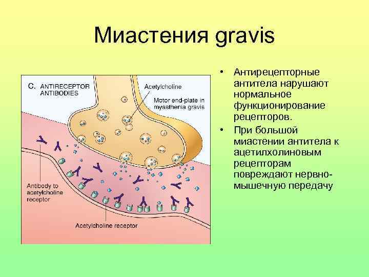 Миастения gravis • Антирецепторные антитела нарушают нормальное функционирование рецепторов. • При большой миастении антитела