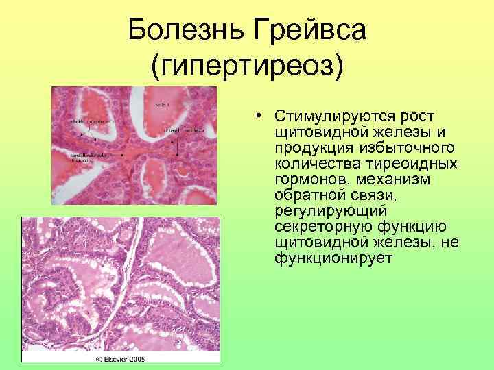 Болезнь грейвса. Патофизиология щитовидной железы. Морфология болезни Грейвса. При болезни Грейвса имеет место продукция. Какие клетки поражаются при болезни Грейвса.