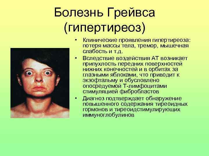 Болезнь Грейвса (гипертиреоз) • Клинические проявления гипертиреоза: потеря массы тела, тремор, мышечная слабость и