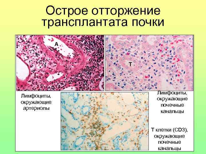 Острое отторжение трансплантата почки Лимфоциты, окружающие артериолы Лимфоциты, окружающие почечные канальцы T клетки (CD