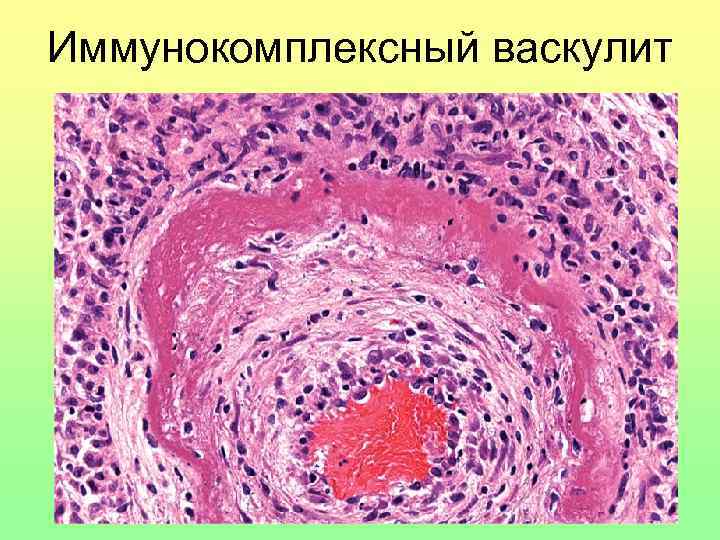 Иммунокомплексный васкулит 