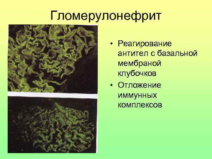 Гломерулонефрит • Реагирование антител с базальной мембраной клубочков • Отложение иммунных комплексов 