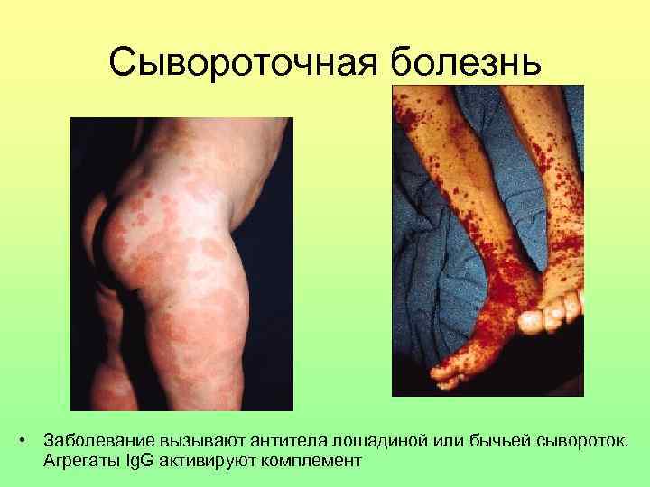 Сывороточная болезнь • Заболевание вызывают антитела лошадиной или бычьей сывороток. Агрегаты Ig. G активируют
