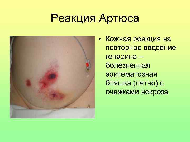 Реакция Артюса • Кожная реакция на повторное введение гепарина – болезненная эритематозная бляшка (пятно)