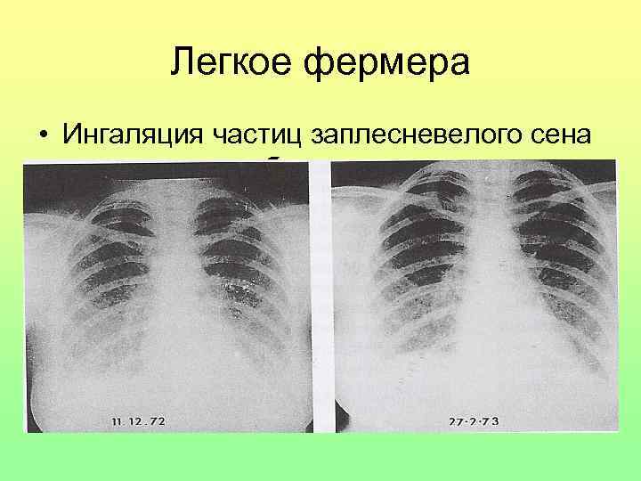 Легкое фермера • Ингаляция частиц заплесневелого сена – протеины грибов 