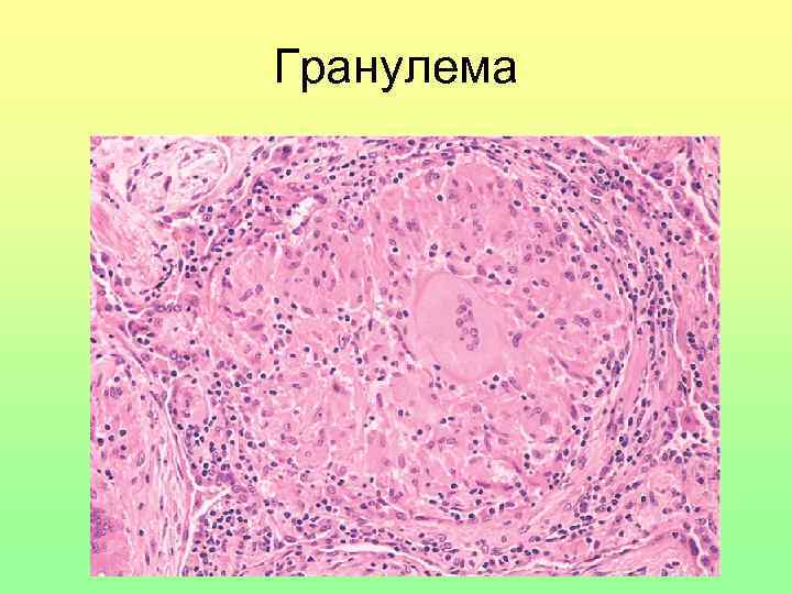 Гранулема 