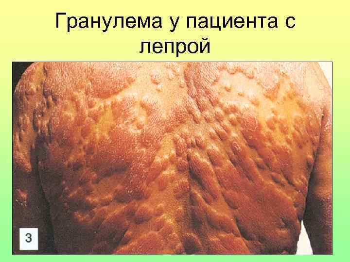 Гранулема у пациента с лепрой 