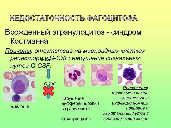 Врожденный агранулоцитоз - синдром Костманна Причины: отсутствие на миелоидных клетках рецептора к G-CSF; нарушение