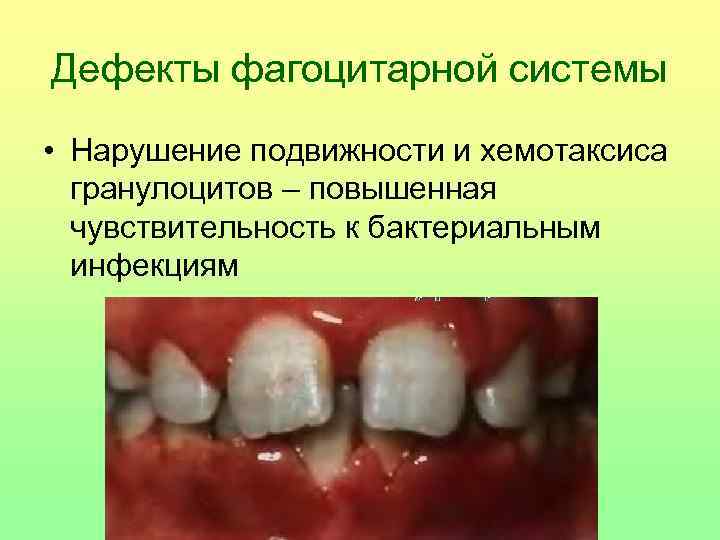 Дефекты фагоцитарной системы • Нарушение подвижности и хемотаксиса гранулоцитов – повышенная чувствительность к бактериальным