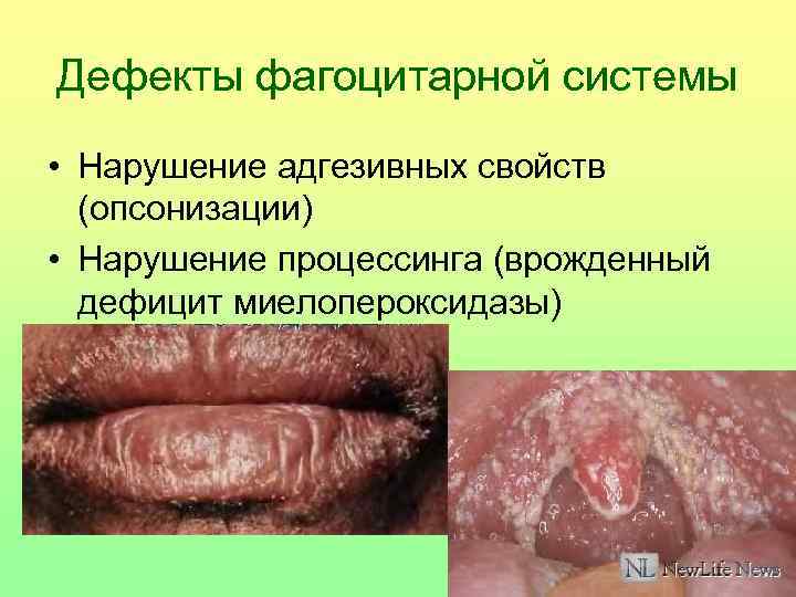 Дефекты фагоцитарной системы • Нарушение адгезивных свойств (опсонизации) • Нарушение процессинга (врожденный дефицит миелопероксидазы)