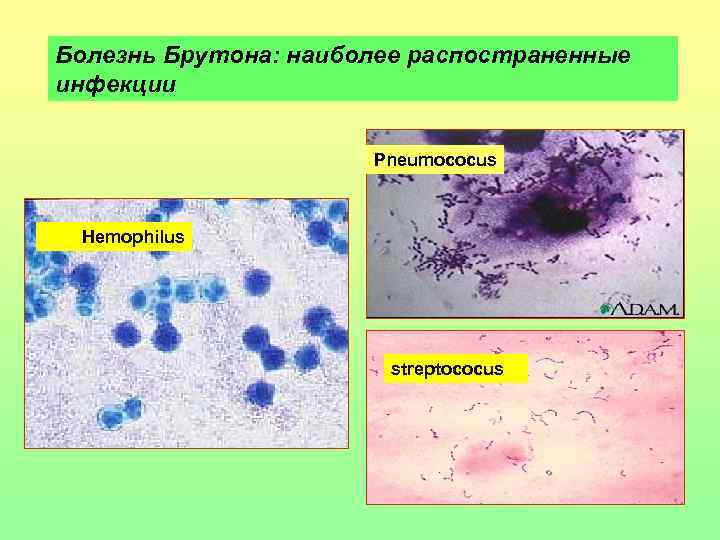 Болезнь Брутона: наиболее распостраненные инфекции Pneumococus Hemophilus streptococus 