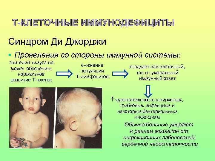 Синдром Ди Джорджи § Проявления со стороны иммунной системы: эпителий тимуса не может обеспечить