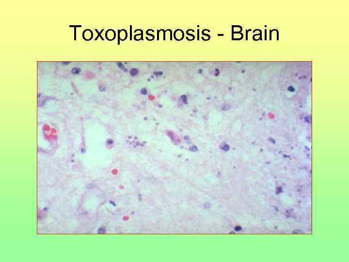 Toxoplasmosis - Brain 