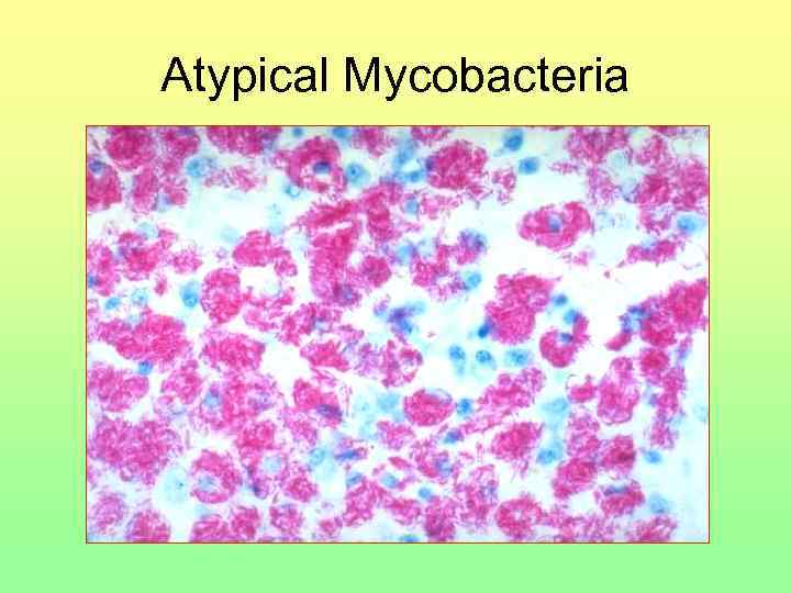 Atypical Mycobacteria 