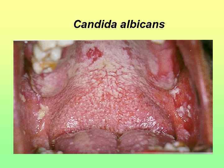 Candida albicans 