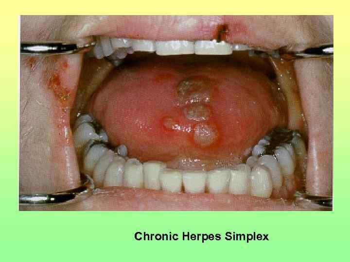 Chronic Herpes Simplex 