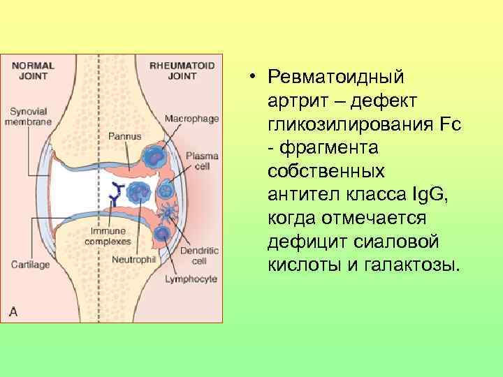  • Ревматоидный артрит – дефект гликозилирования Fc - фрагмента собственных антител класса Ig.