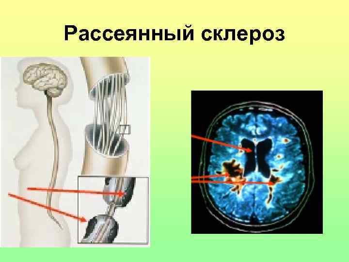 Рассеянный склероз 