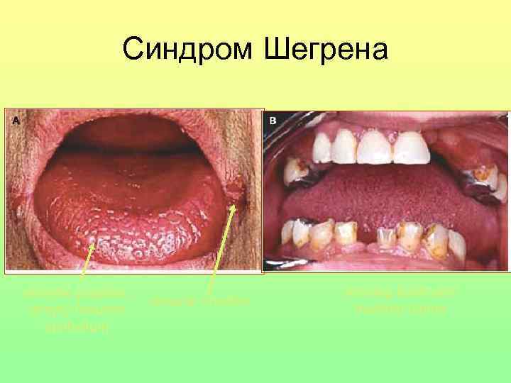 Синдром Шегрена atrophic papillae, deeply fissured epithelium angular cheilitis missing teeth and multiple caries