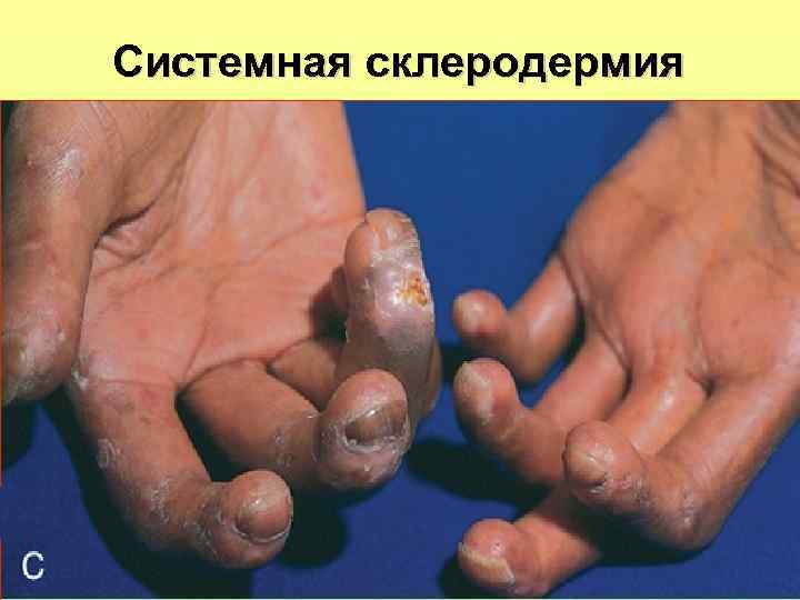 Системная склеродермия 