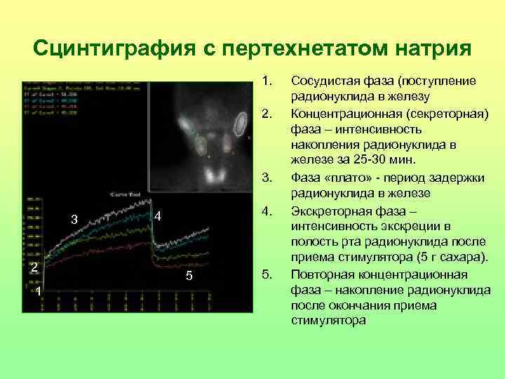 Сцинтиграфия с пертехнетатом натрия 1. 2. 3. 3 2 1 4. 4 5 5.