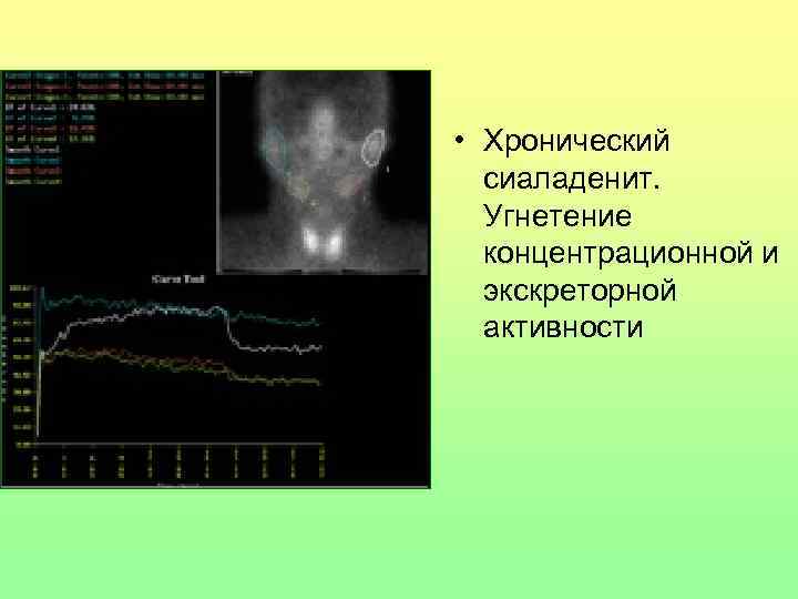  • Хронический сиаладенит. Угнетение концентрационной и экскреторной активности 