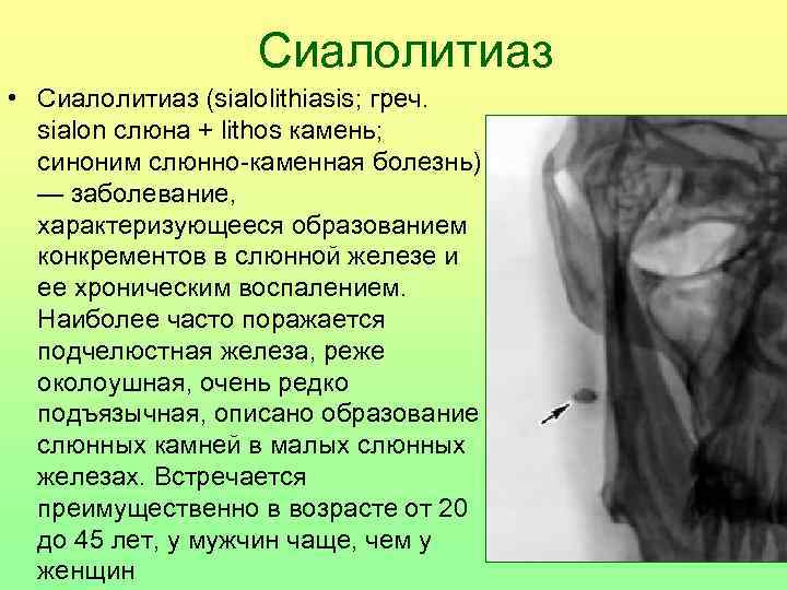 Сиалолитиаз • Сиалолитиаз (sialolithiasis; греч. sialon слюна + lithos камень; синоним слюнно-каменная болезнь) —