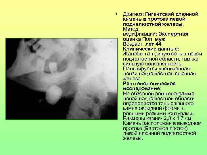  • Диагноз: Гигантский слюнной камень в протоке левой подчелюстной железы. Метод верификации: Экспертная