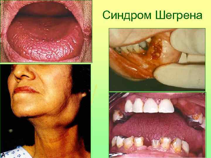 Синдром Шегрена 