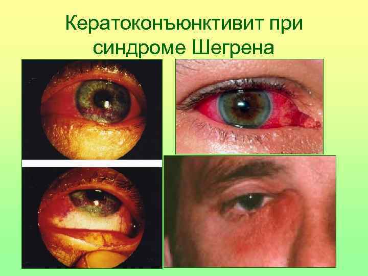 Кератоконъюнктивит при синдроме Шегрена 