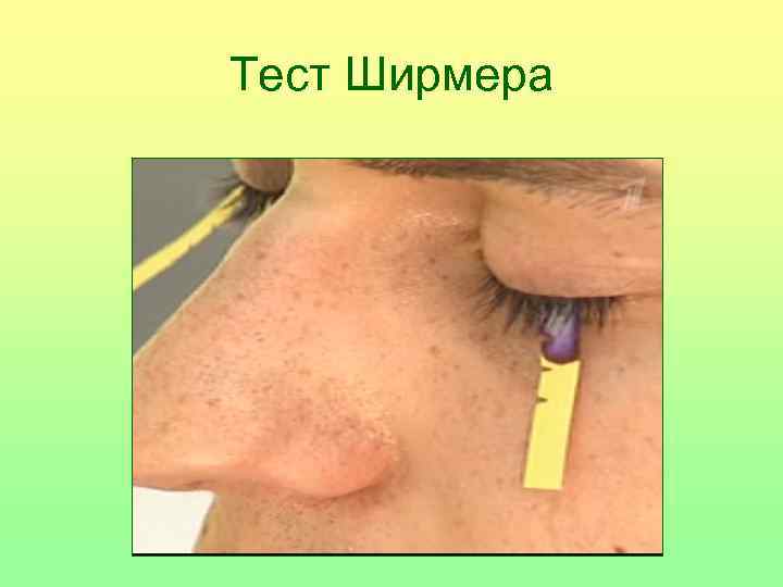 Тест Ширмера 
