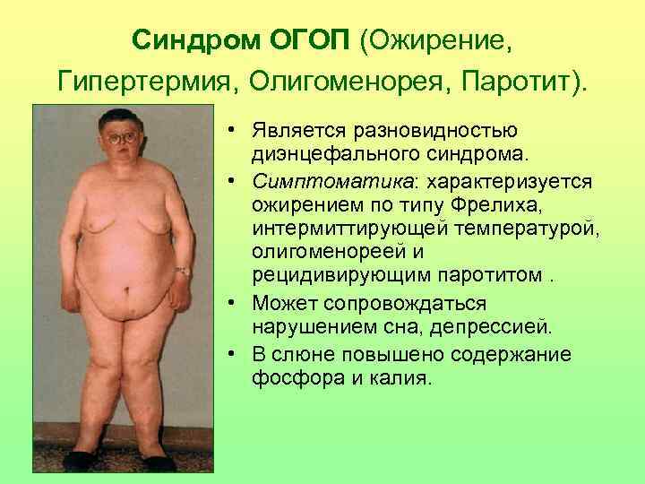 Синдром ОГОП (Ожирение, Гипертермия, Олигоменорея, Паротит). • Является разновидностью диэнцефального синдрома. • Симптоматика: характеризуется