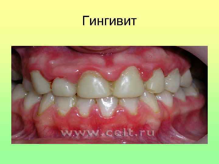 Гингивит 
