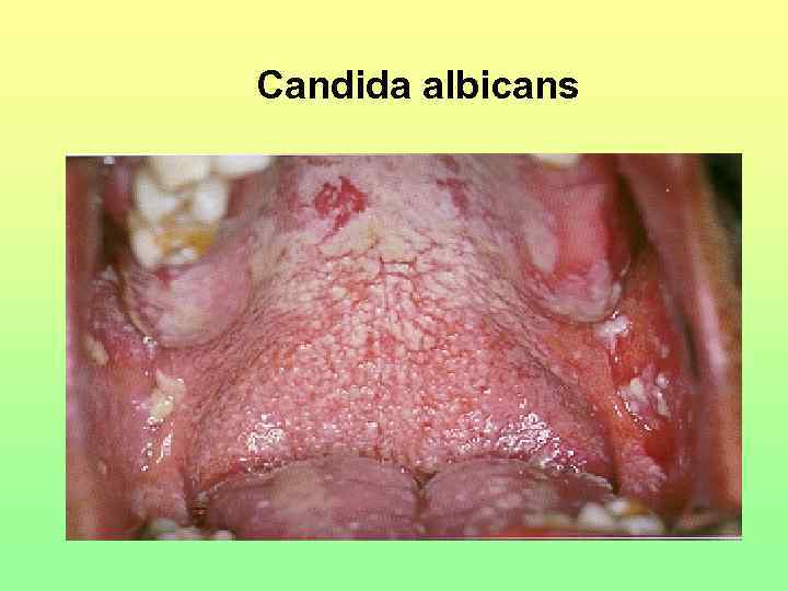 Candida albicans 