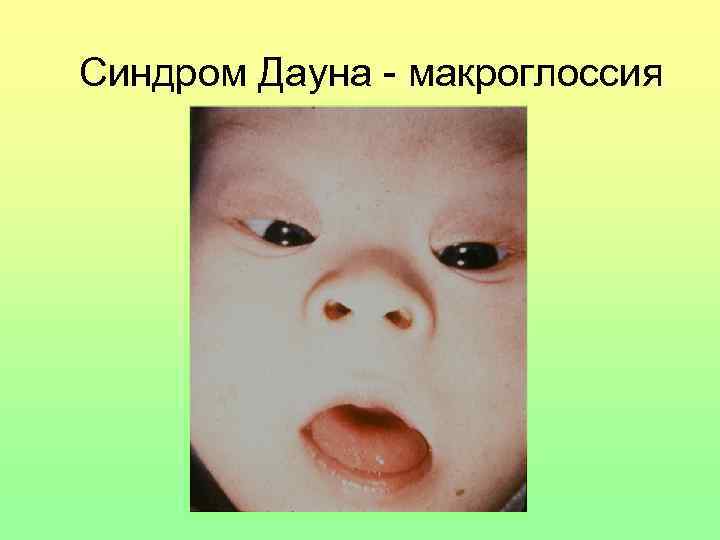 Синдром Дауна - макроглоссия 