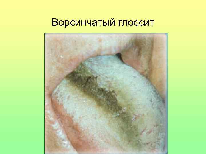 Ворсинчатый глоссит 