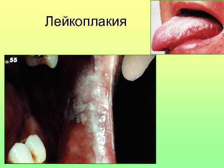 Лейкоплакия 