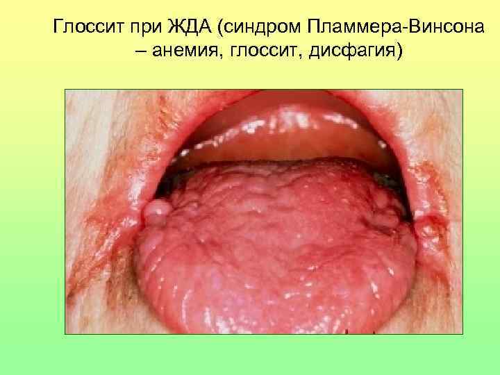 Глоссит при ЖДА (синдром Пламмера-Винсона – анемия, глоссит, дисфагия) 
