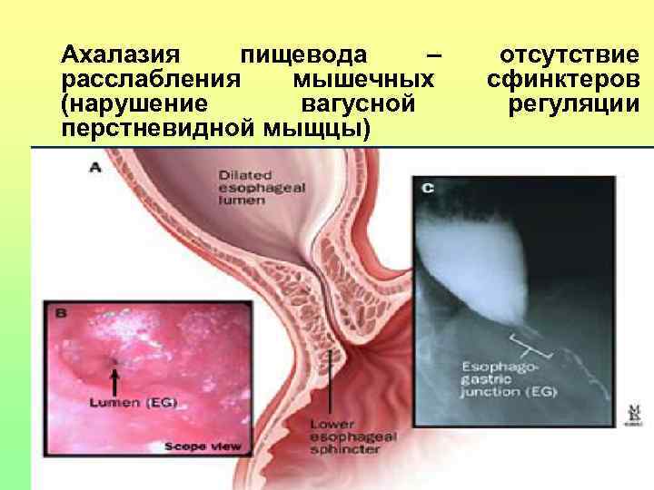 Ахалазия пищевода – расслабления мышечных (нарушение вагусной перстневидной мыщцы) отсутствие сфинктеров регуляции 